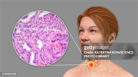 Thyroid Gland Histology Photos and Premium High Res Pictures - Getty Images