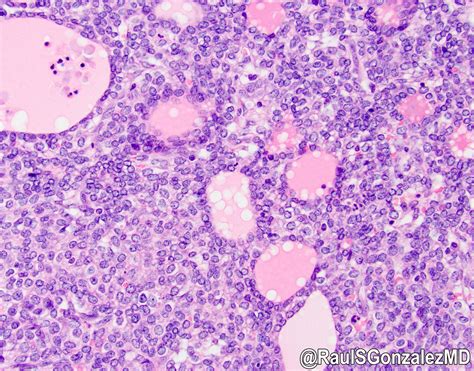 Pathology Outlines Intrahepatic Cholangiocarcinoma Small And Large