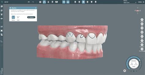 Dental 3D Modeling Software | Orthodontic CAD Software