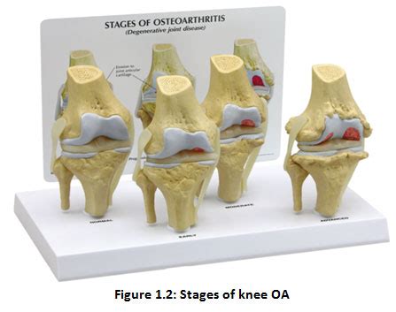 overview  medical imaging techniques  knee osteoarthritis