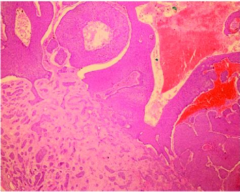 Nodular And Infiltrative Type Basal Cell Carcinoma At The Base Of