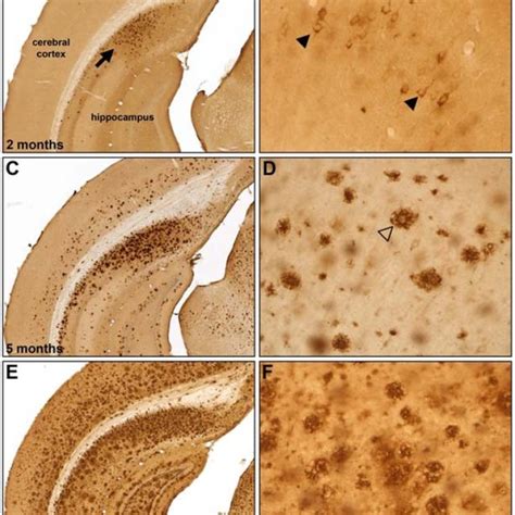 Quantification Of Amyloid A Plaque Burden In Different Brain