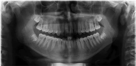 Dental X Rays Explained By Your Idaho Falls Dentist