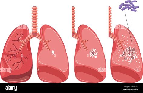 Tuberculosis In Human Lungs Illustration Stock Vector Image And Art Alamy