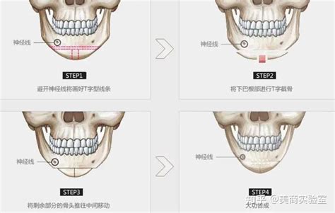一篇教你改善下巴短和下巴后缩，下巴整形有几种方式？玻尿酸填充下巴靠谱吗？ 知乎