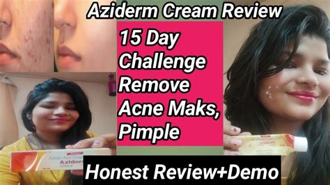 Azederm Cream Reviewaziderm Cream Side Effectiveaziderm 20 Cream एज़िडेर्म् क्रीम Youtube