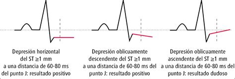 Prueba De Esfuerzo Electrocardiogr Fica Electrocardiograf A Pruebas