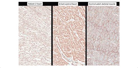 Immunohistochemistry With Anti Alpha Dystroglycan Clone Via4 1