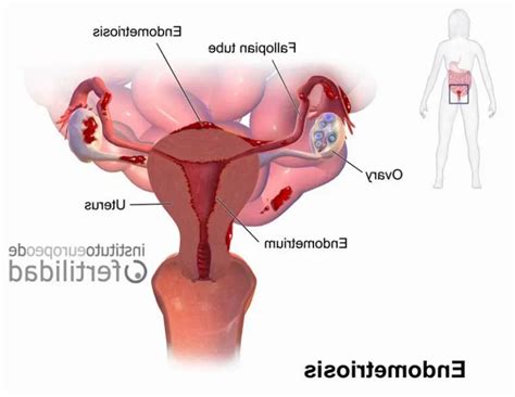 Ovulación y endometriosis cómo afecta a la fertilidad