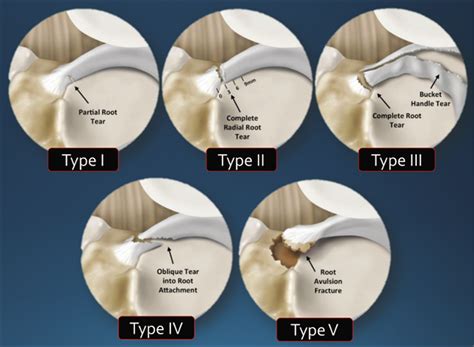 Medial Meniscus