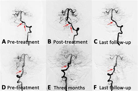 Endovascular Treatment Of Bilateral Intracranial Vertebral Artery