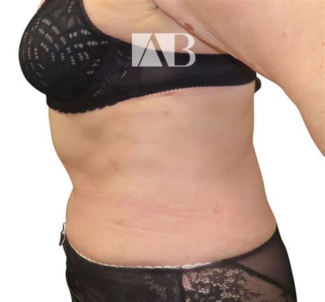 Tummy Tuck Before And After Patient 3 Left Anca Breahna Plastic