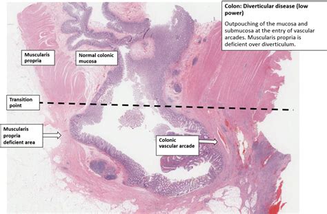 Large Intestine Diverticular Disease Nus Pathweb Nus Pathweb