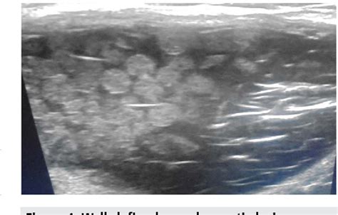 Figure 1 From An Unusual Sonographic Appearance Of A Dermoid Cyst In A