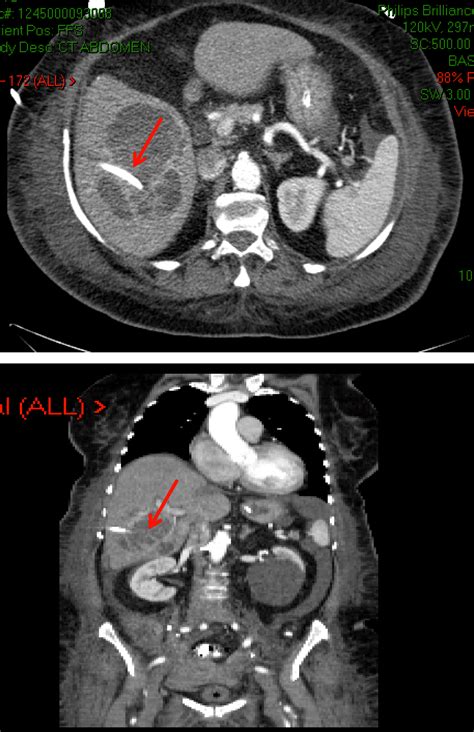 Percutaneous Drainage Of Diverticular Abscess - Best Drain Photos Primagem.Org