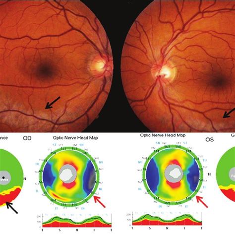 Fundus Pictures Showing Patches Of Retinochoroidal Atrophy Arrows And