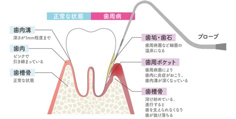 歯周ポケットの測定方法と深さ別の治療法 西田辺阿倍野区の歯医者 歯周病｜西田辺えがしら歯科