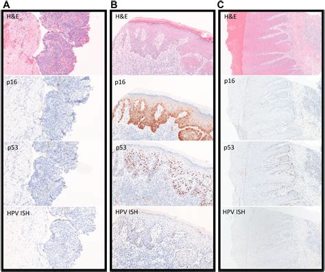 Classification Of Vulvar Squamous Cell Carcinoma And Precursor Lesions