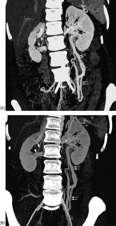 Multidetector Row Ct Angiography Of Living Related Renal Donors Is