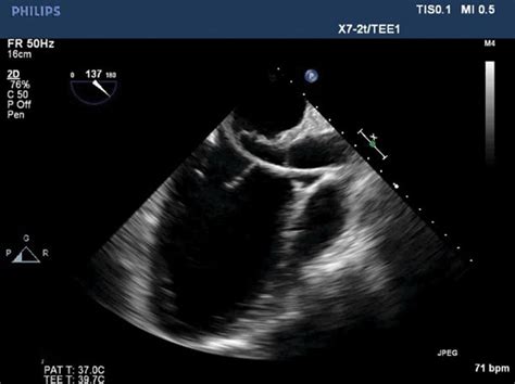 Fluoroscopy Showing Catheter Across Anterior Mitral Leaflet Perforation