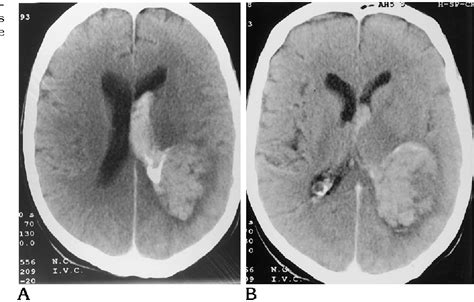 Figure 2 From Intraventricular Hemorrhage Caused By Intraventricular