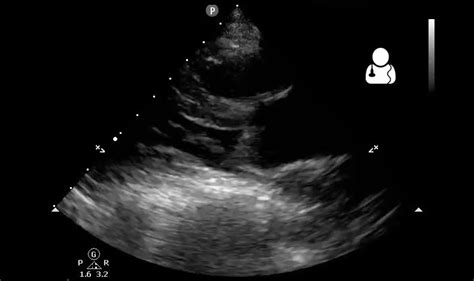 Thoracic ultrasound certified training programme – part one - ERS ...