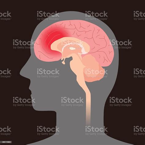 Cerebral Hemorrhage Image Illustration Stock Illustration Download