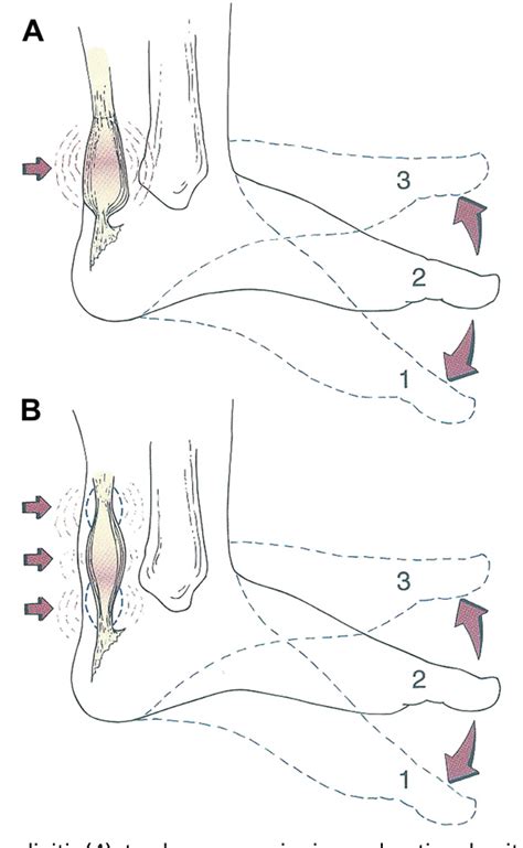 Figure 1 From Surgical Treatment Of Non Insertional Achilles Tendinitis Semantic Scholar