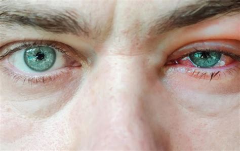 Chlamydia Eye Infection: Causes, Symptoms, Treatment | OBN