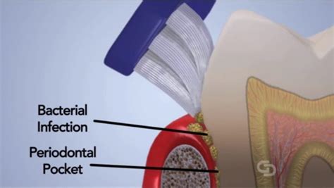 Perio Protect - Towngate Dentall