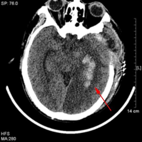 The Head Ct Revealed New Intracranial Hemorrhage On Icu Day 10 Red Arrow Download Scientific