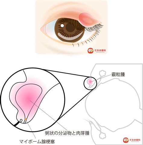 ものもらい（霰粒腫・麦粒腫） 治療メニュー だるま眼科（群馬県高崎市）