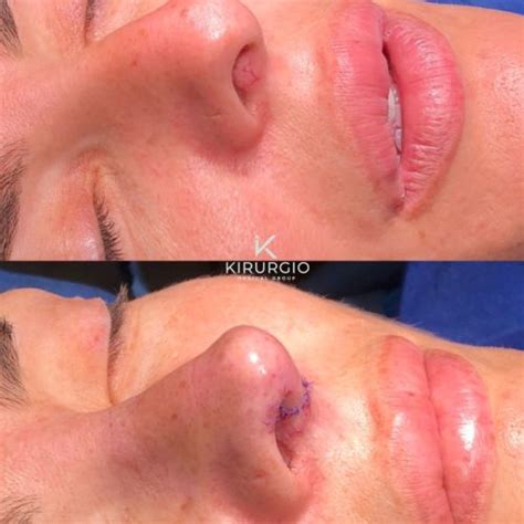 Rinoplastia Barcelona Kirurgio Medical Center