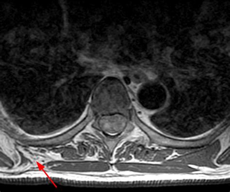 Winged Scapula Xray