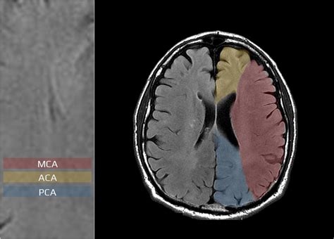 Anatomy of cerebral arteries | STROKE MANUAL