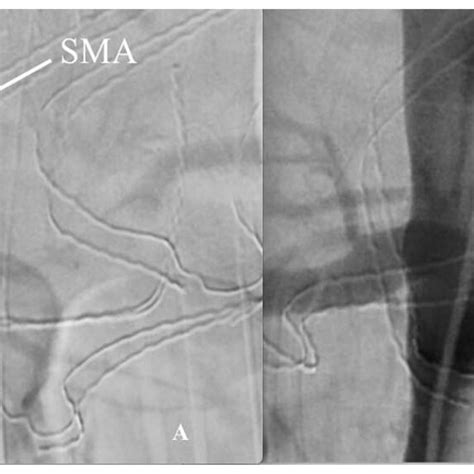 Angiography with evidence of the SMA obstruction by dissection... | Download Scientific Diagram