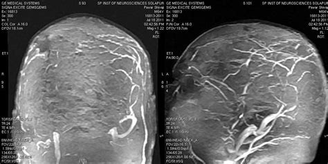 Dr Balaji Anvekar Frcr Hypertrophic Patchymeningitis Mri