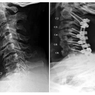 Patient 1 Lateral And Anterior Posterior Upright Cervical X Ray After