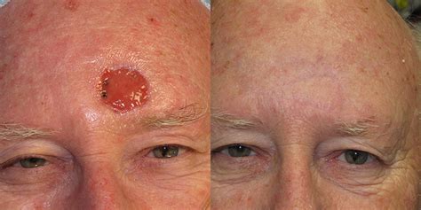 Forehead Reconstruction Gallery Skin Cancer And Reconstructive