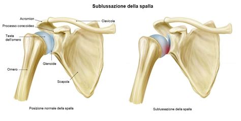 Lussazione Gleno Omerale Spalla Clinic