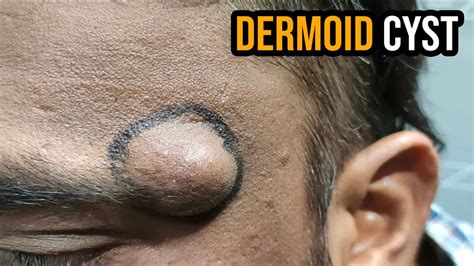 Dermoid Cyst Removal On Face Video Spotter