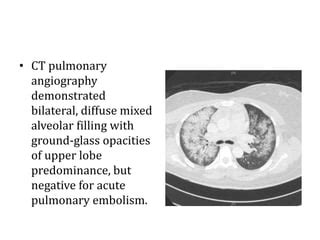 Neurogenic Pulmonary Edema Ppt