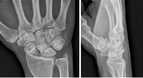 Scaphoid Fracture Avascular Necrosis