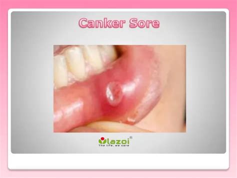 Ppt Canker Sores Causes And Home Remedies Powerpoint Presentation