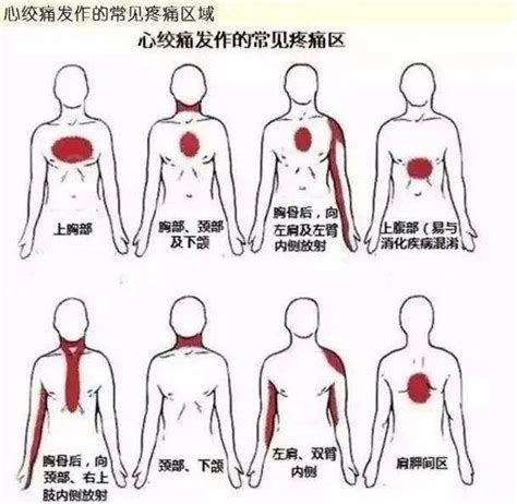 教你从5个方面辨别心绞痛！ 知乎