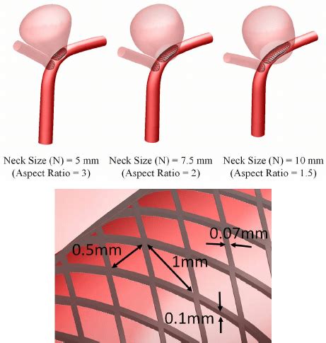 Three Dimensional Perspective Of Intracranial Aneurysm Model With Stent