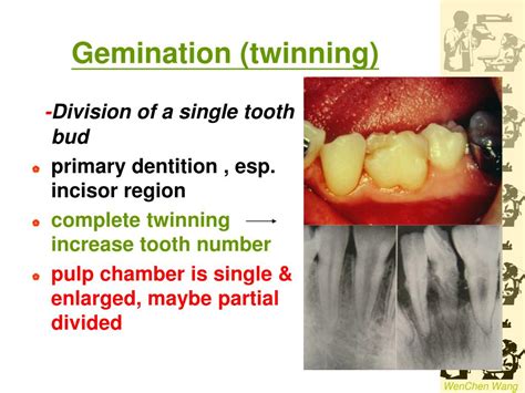 Ppt Dental Anomalies In Radiology Powerpoint Presentation Free