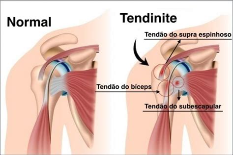 Tendinite Causas Por Que Ocorre E Como Cuidar