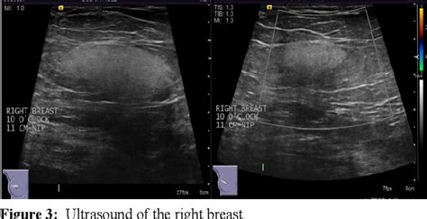 Figure 1 From Spindle Cell Lipoma Rare Breast Mass Imaging Findings And Differential Diagnosis