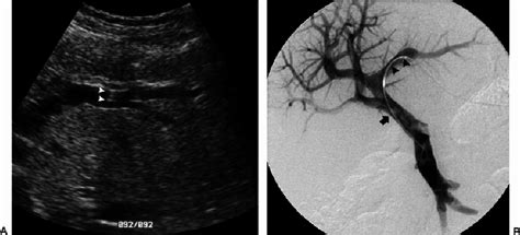 Ultrasound Guided Percutaneous Left Portal Vein Access Images